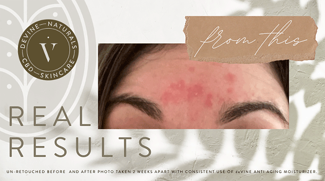 A close-up of a persons forehead with visible red patches promotes DeVINE Wellness deVINE Anti Aging Moisturizer. Text reads Real Results and From this, highlighting the before state in a hydration and anti-aging skincare comparison.